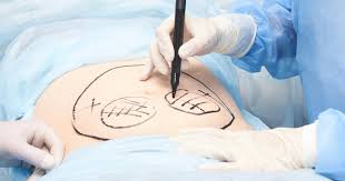 The Dubai Tummy Tuck Decision: A Clear Look at What's Involved