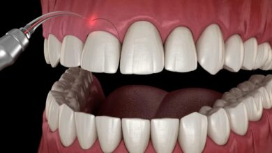 Laser Gum Surgery Houston TX A Gentle Breakthrough for Healthier Gums