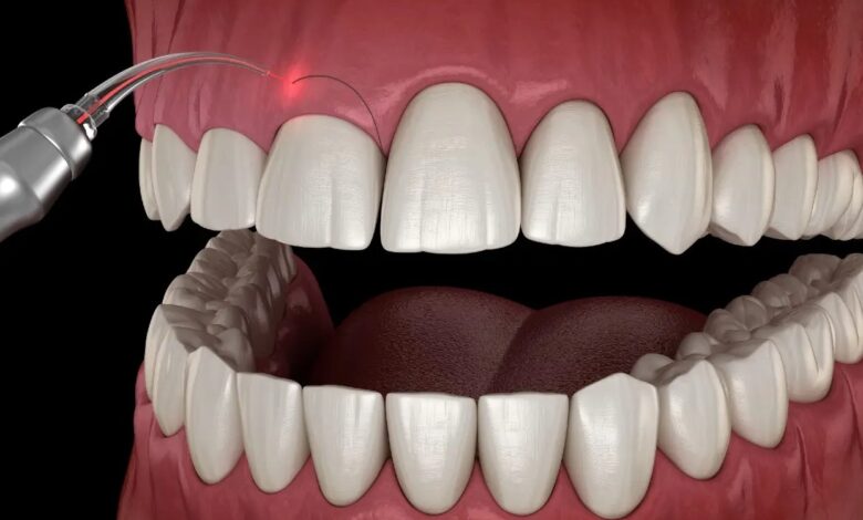 Laser Gum Surgery Houston TX A Gentle Breakthrough for Healthier Gums